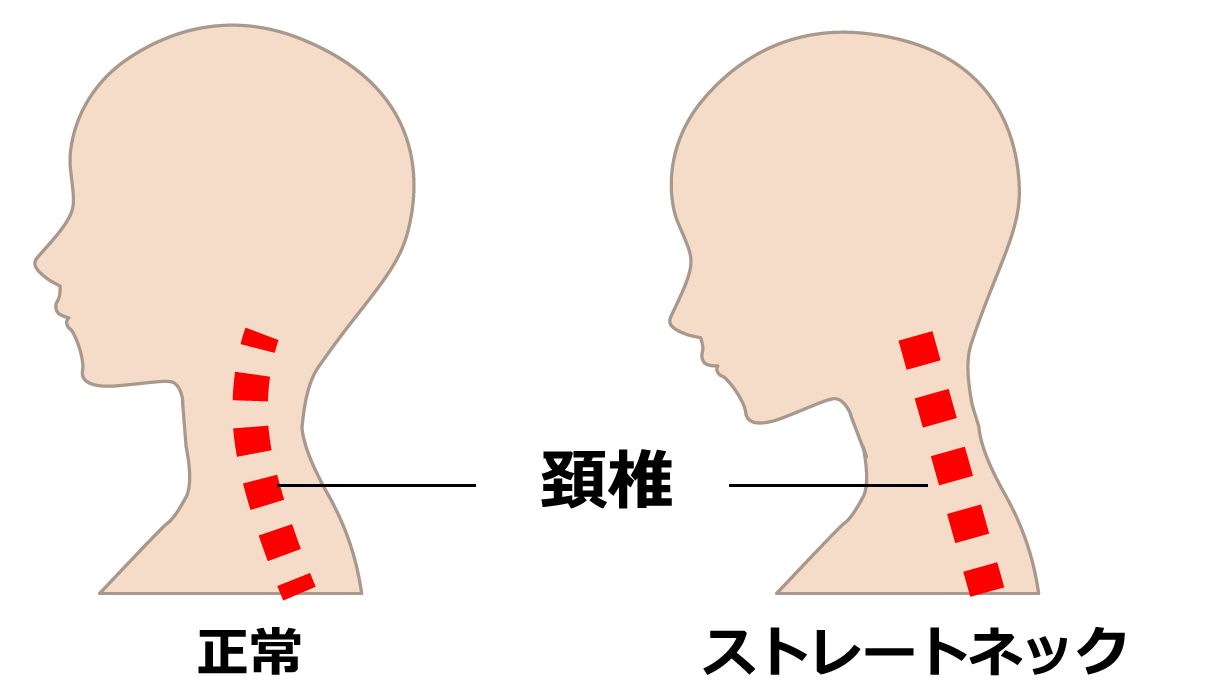 ストレートネックのイラスト