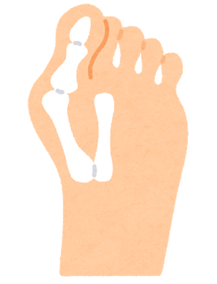 外反母趾のイラスト