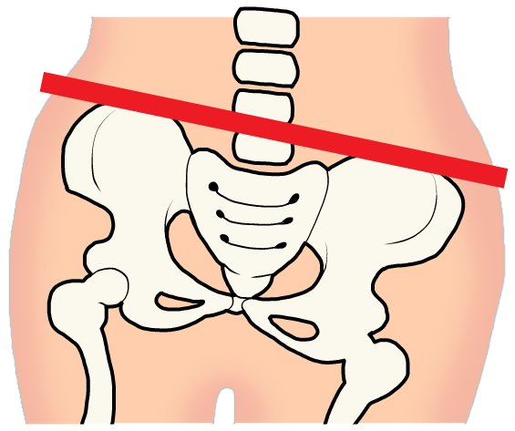 骨盤の歪みのイラスト
