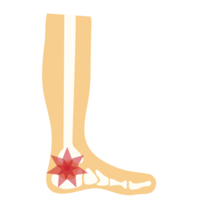 かかとの痛みのイラスト